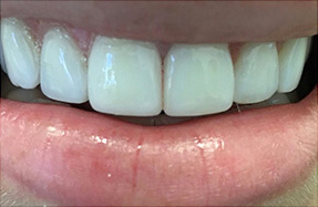 After the treatment case 1