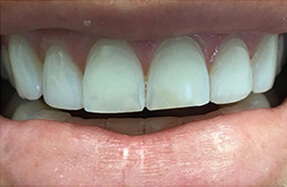 Before the treatment case 1